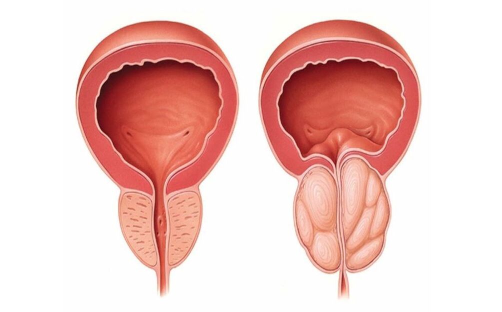 normálna a zapálená prostata