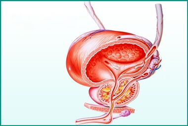 Zápal prostaty pri akútnej prostatitíde je obmedzenie pre sex