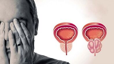 Dôvody rozvoja prostatitídy u mužov