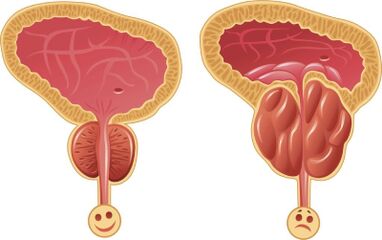Zdravá a zapálená mužská prostata
